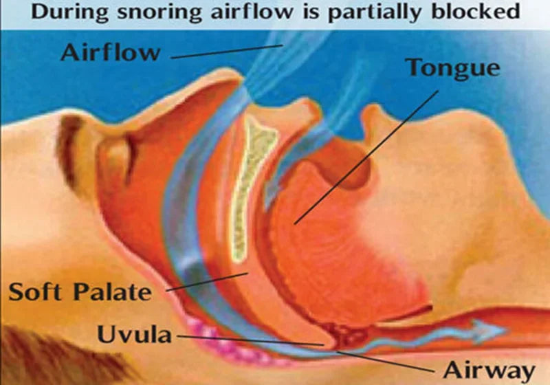 Professional Anti Snoring Device For Men Women